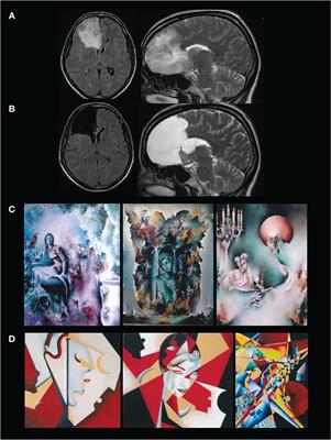 Case report: when art is faced with brain surgery: acute change in creative style in a painter after glioma resection